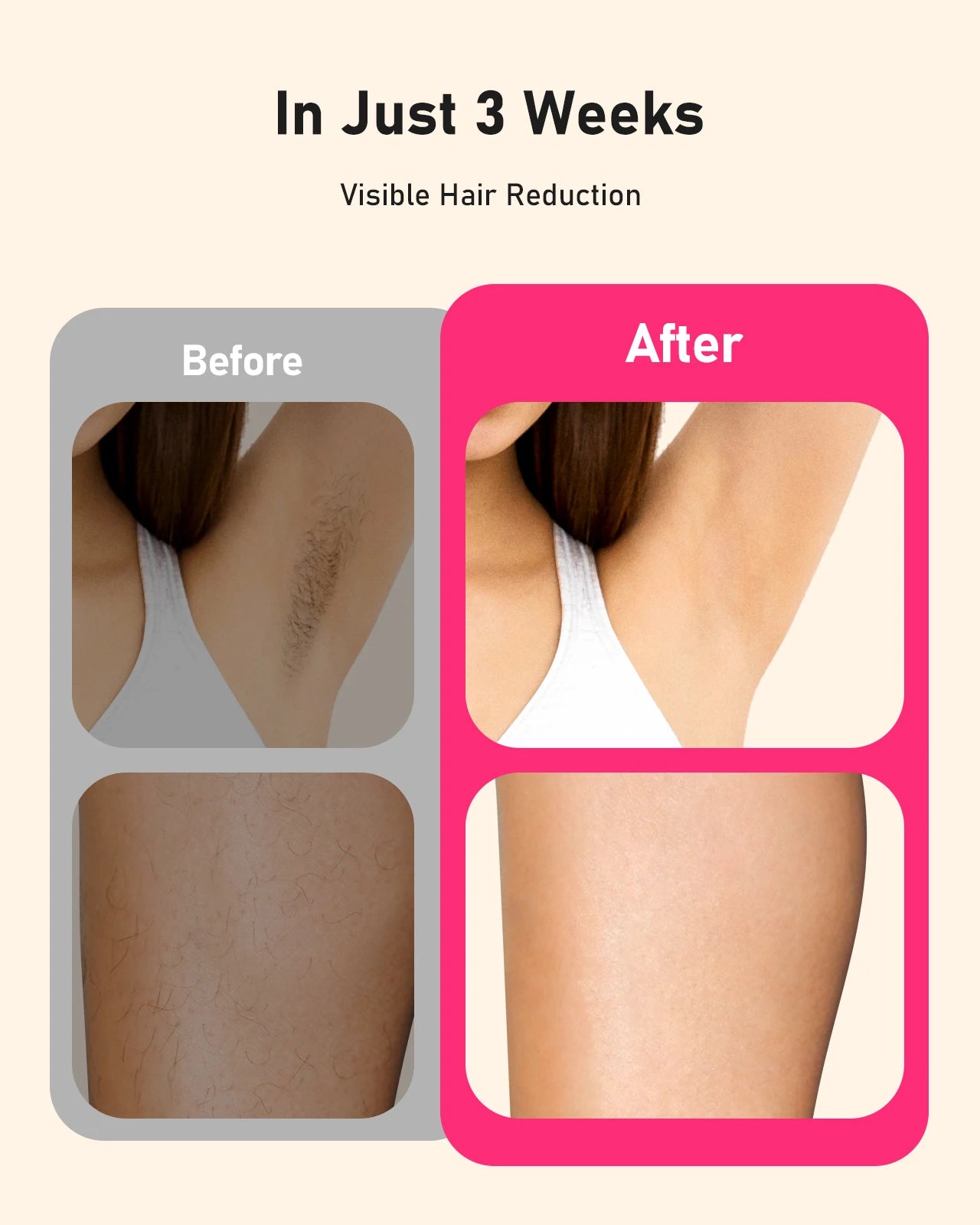 JOOYEECertification IPL Laser Hair Removal Device 3in1 For Home Use